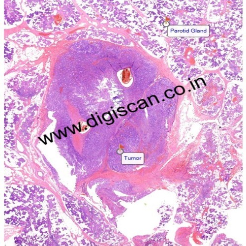 MDS Immunohistochemistry (IHC) Digital Slides Set