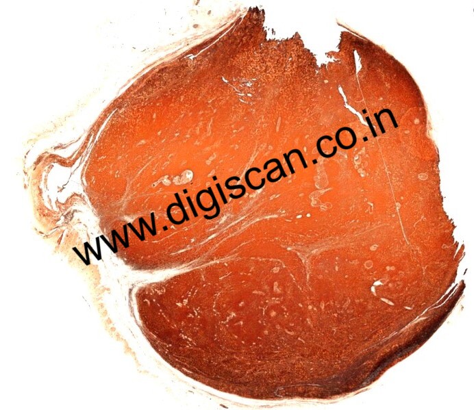 MDS Immunohistochemistry (IHC) Digital Slides Set