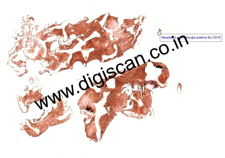 MDS Immunohistochemistry (IHC) Digital Slides Set